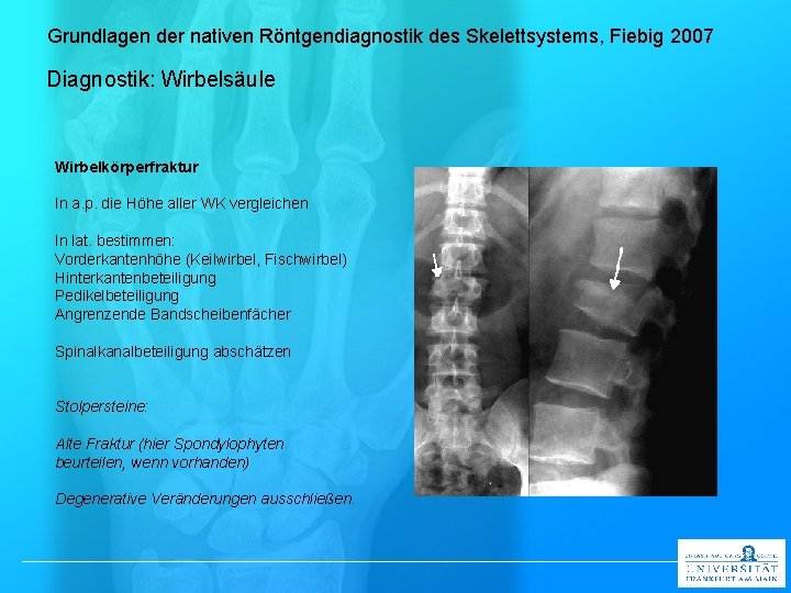 Grundlagen der nativen Röntgendiagnostik des Skelettsystems, Fiebig 2007 Diagnostik: Wirbelsäule Wirbelkörperfraktur In a. p.