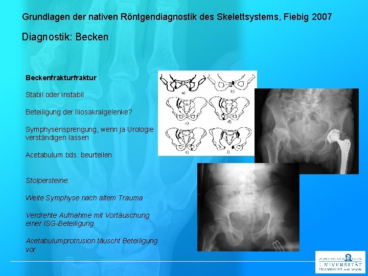 Grundlagen der nativen Röntgendiagnostik des Skelettsystems, Fiebig 2007 Diagnostik: Beckenfraktur Stabil oder instabil Beteiligung