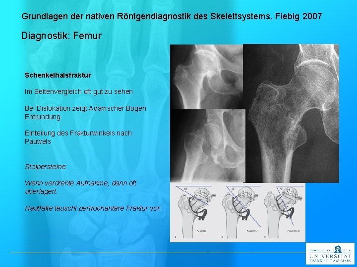 Grundlagen der nativen Röntgendiagnostik des Skelettsystems, Fiebig 2007 Diagnostik: Femur Schenkelhalsfraktur Im Seitenvergleich oft