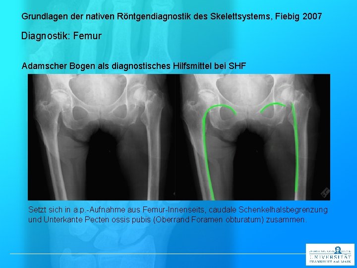 Grundlagen der nativen Röntgendiagnostik des Skelettsystems, Fiebig 2007 Diagnostik: Femur Adamscher Bogen als diagnostisches