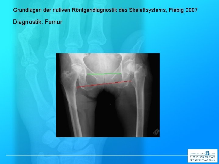 Grundlagen der nativen Röntgendiagnostik des Skelettsystems, Fiebig 2007 Diagnostik: Femur 