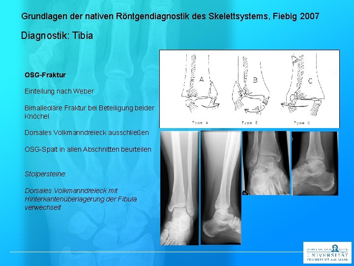 Grundlagen der nativen Röntgendiagnostik des Skelettsystems, Fiebig 2007 Diagnostik: Tibia OSG-Fraktur Einteilung nach Weber