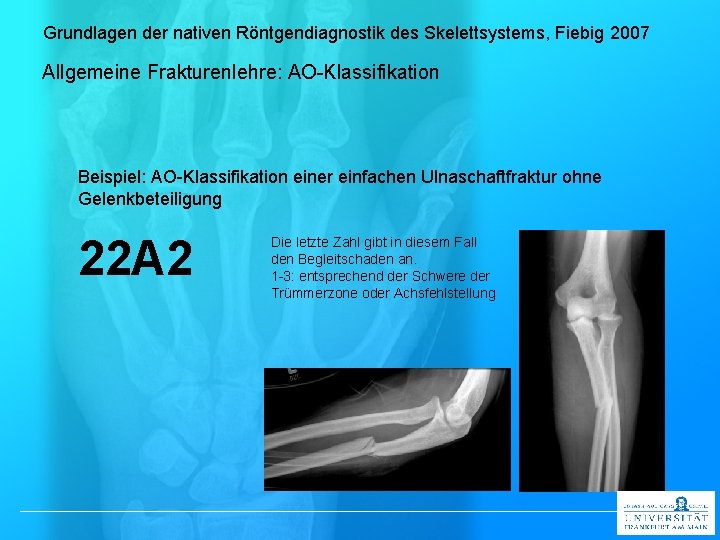 Grundlagen der nativen Röntgendiagnostik des Skelettsystems, Fiebig 2007 Allgemeine Frakturenlehre: AO-Klassifikation Beispiel: AO-Klassifikation einer