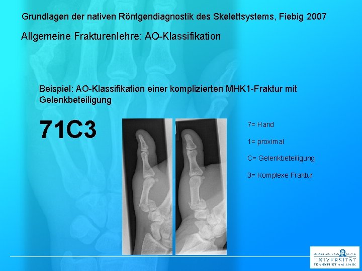 Grundlagen der nativen Röntgendiagnostik des Skelettsystems, Fiebig 2007 Allgemeine Frakturenlehre: AO-Klassifikation Beispiel: AO-Klassifikation einer