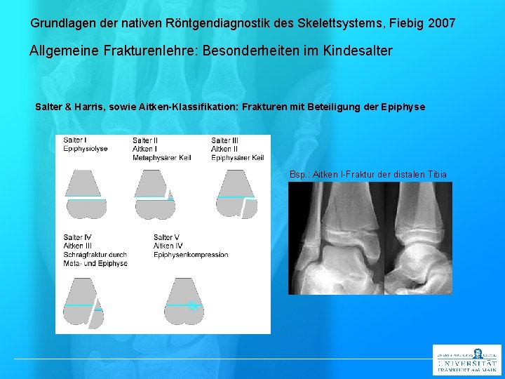 Grundlagen der nativen Röntgendiagnostik des Skelettsystems, Fiebig 2007 Allgemeine Frakturenlehre: Besonderheiten im Kindesalter Salter