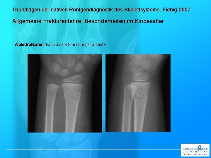 Grundlagen der nativen Röntgendiagnostik des Skelettsystems, Fiebig 2007 Allgemeine Frakturenlehre: Besonderheiten im Kindesalter Wulstfrakturen