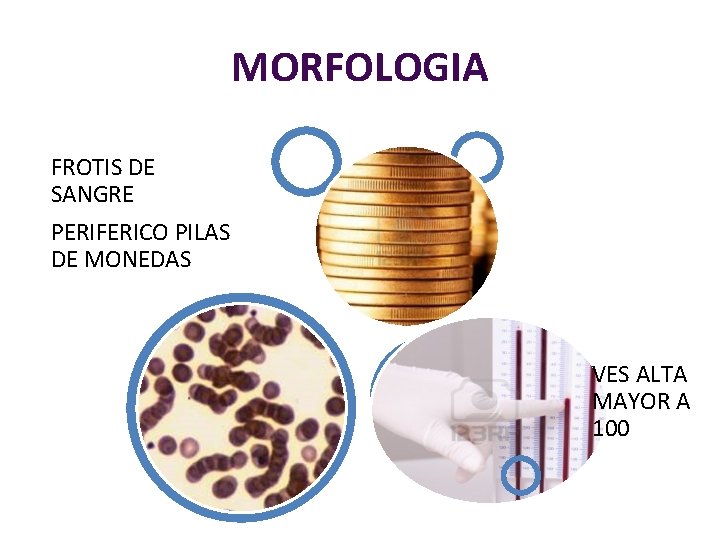 MORFOLOGIA FROTIS DE SANGRE PERIFERICO PILAS DE MONEDAS VES ALTA MAYOR A 100 