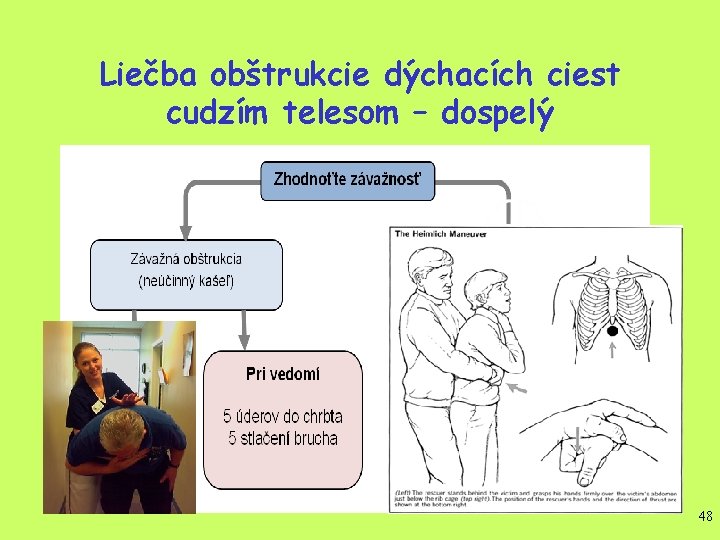 Liečba obštrukcie dýchacích ciest cudzím telesom – dospelý 48 