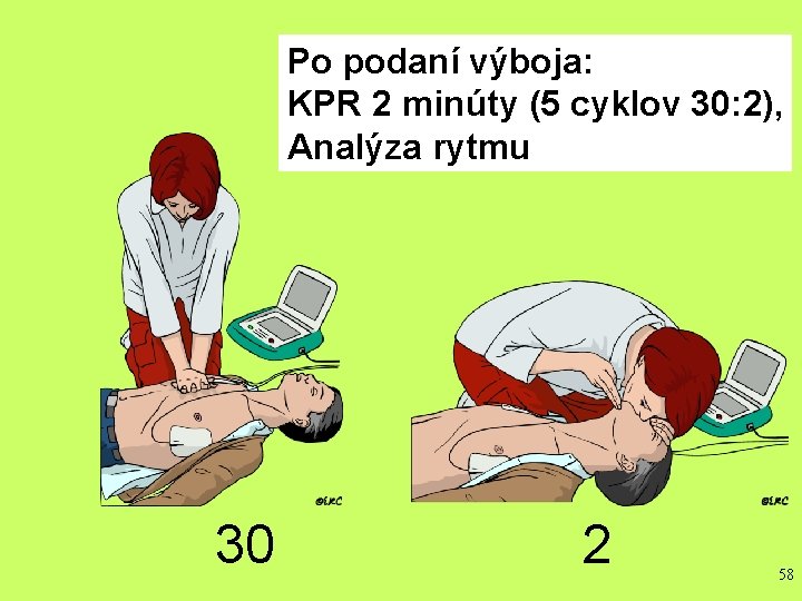 Po podaní výboja: SHOCK DELIVERED FOLLOW AED INSTRUCTIONS KPR 2 minúty (5 cyklov 30: