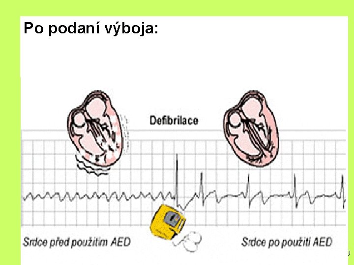 SHOCK DELIVERED Po podaní výboja: FOLLOW AED INSTRUCTIONS 30 2 59 