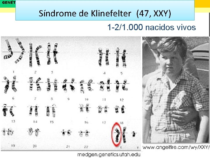 GENÉTICA LEYES DE MENDEL Biología y Geología 4º ESO Síndrome de Klinefelter (47, XXY)