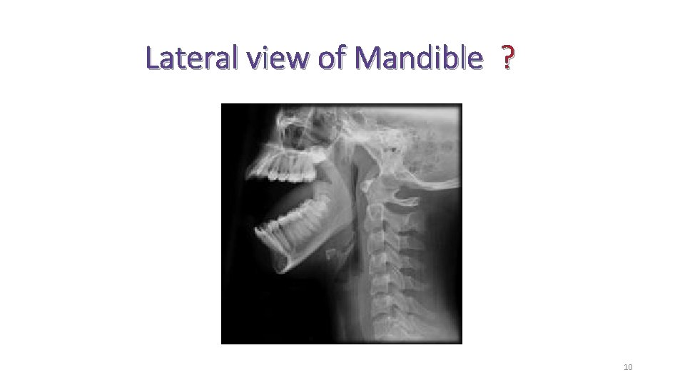 Lateral view of Mandible ? 10 