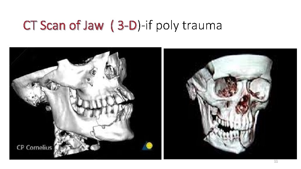 CT Scan of Jaw ( 3 -D)-if 3 -D poly trauma 11 