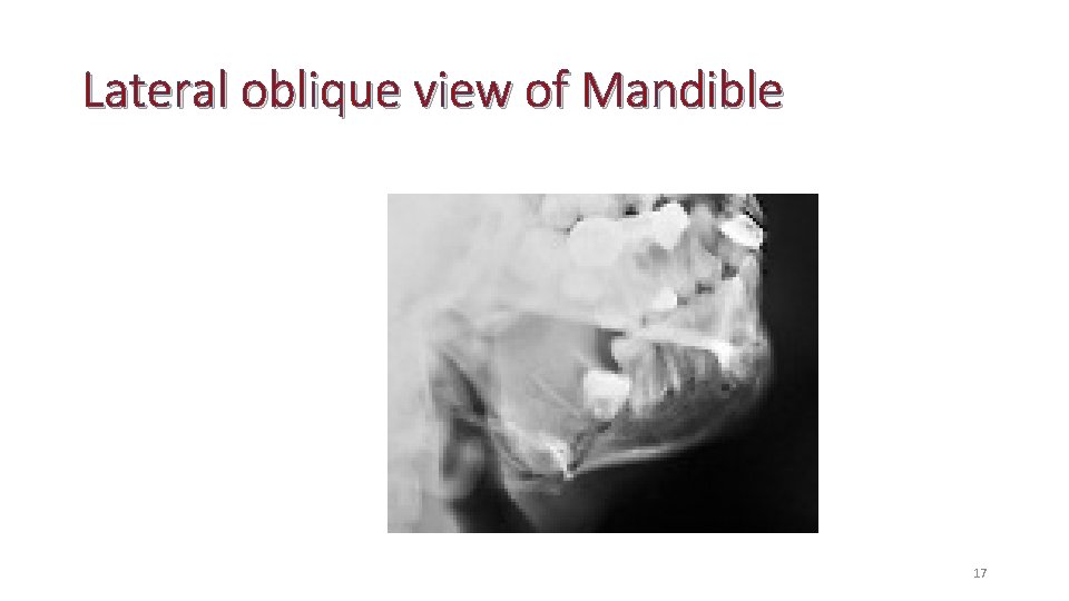 Lateral oblique view of Mandible 17 