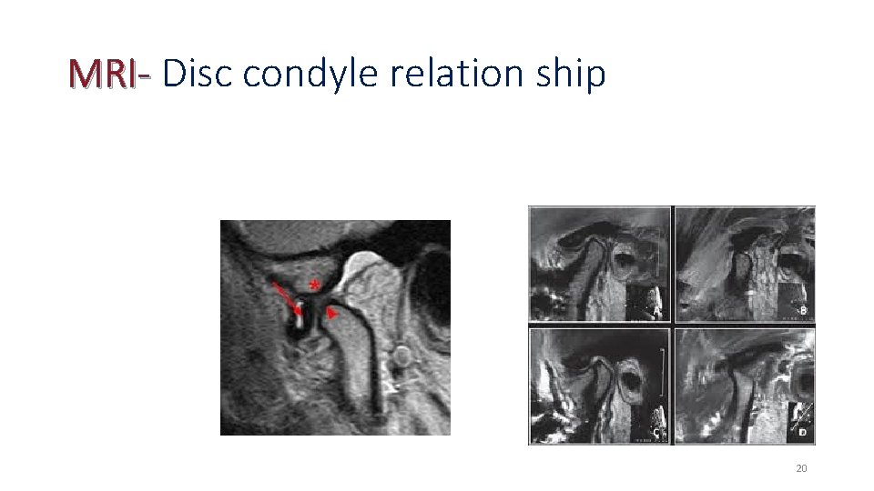 MRI- Disc condyle relation ship 20 