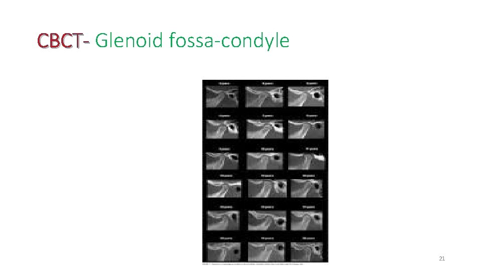 CBCT- Glenoid fossa-condyle 21 
