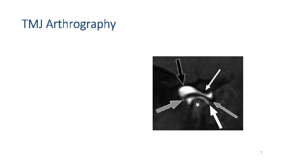 TMJ Arthrography 7 