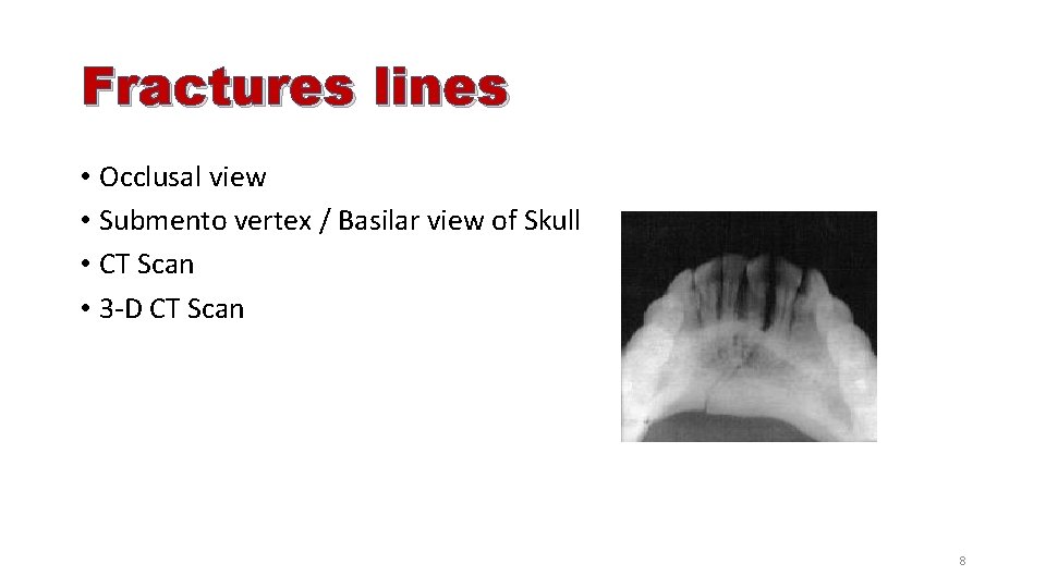 Fractures lines • Occlusal view • Submento vertex / Basilar view of Skull •