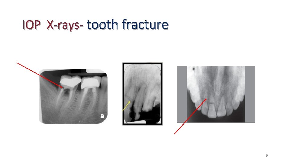 IOP X-rays- tooth fracture 9 