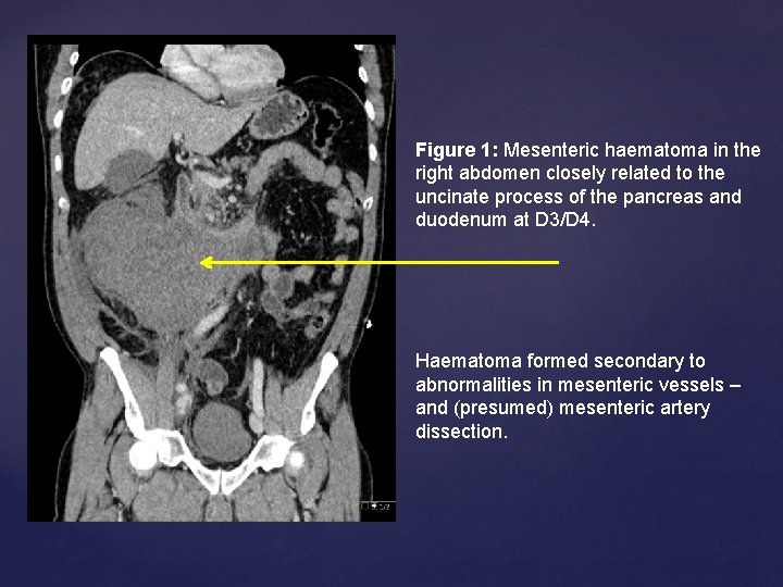 Figure 1: Mesenteric haematoma in the right abdomen closely related to the uncinate process