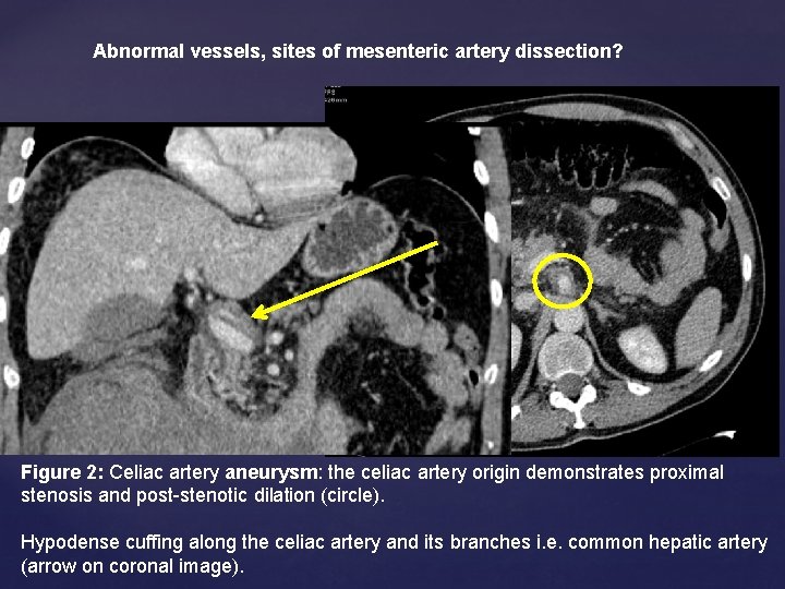 Abnormal vessels, sites of mesenteric artery dissection? Figure 2: Celiac artery aneurysm: the celiac