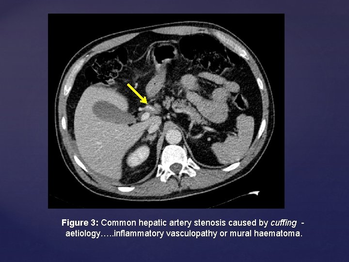 Figure 3: Common hepatic artery stenosis caused by cuffing aetiology…. . inflammatory vasculopathy or