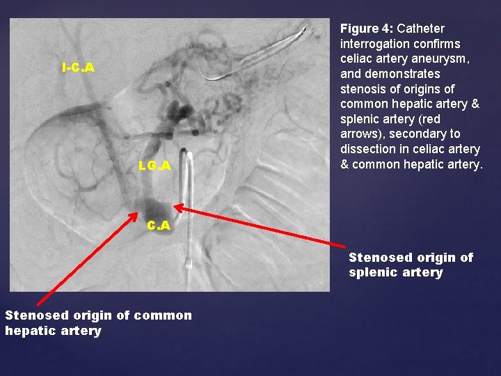 I-C. A LG. A Figure 4: Catheter interrogation confirms celiac artery aneurysm, and demonstrates