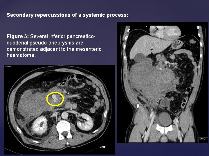 Secondary repercussions of a systemic process: Figure 5: Several inferior pancreaticoduodenal pseudo-aneurysms are demonstrated