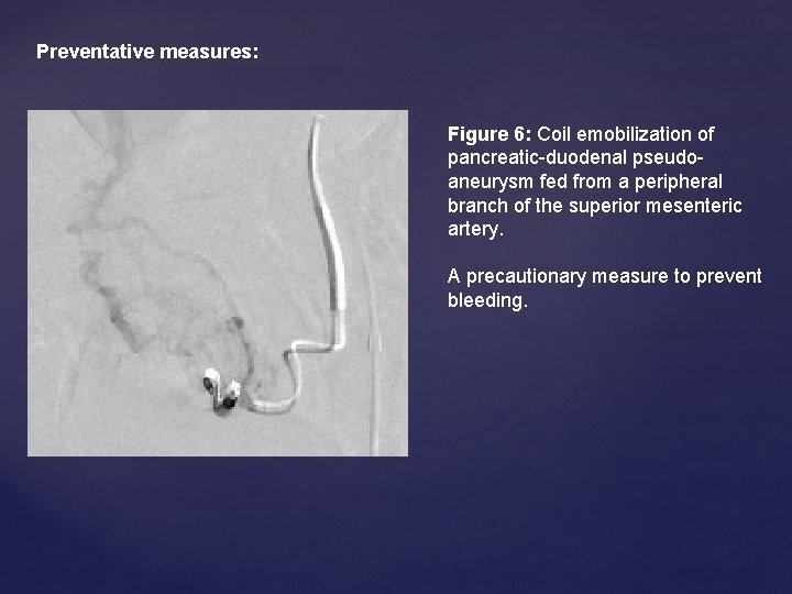 Preventative measures: Figure 6: Coil emobilization of pancreatic-duodenal pseudoaneurysm fed from a peripheral branch