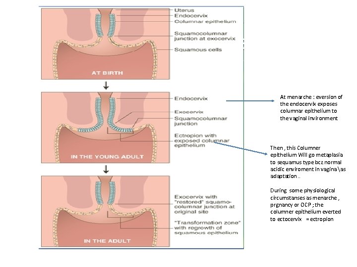 At menarche : eversion of the endocervix exposes columnar epithelium to the vaginal invironment