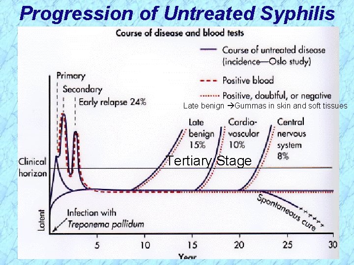 Progression of Untreated Syphilis Late benign Gummas in skin and soft tissues Tertiary Stage