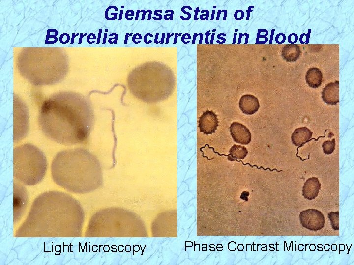 Giemsa Stain of Borrelia recurrentis in Blood Light Microscopy Phase Contrast Microscopy 