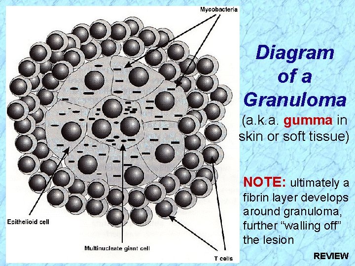 Diagram of a Granuloma (a. k. a. gumma in skin or soft tissue) NOTE: