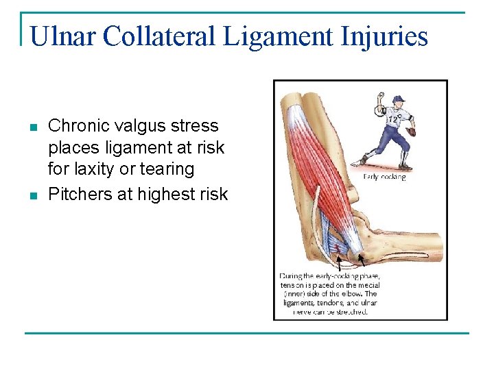 Ulnar Collateral Ligament Injuries n n Chronic valgus stress places ligament at risk for