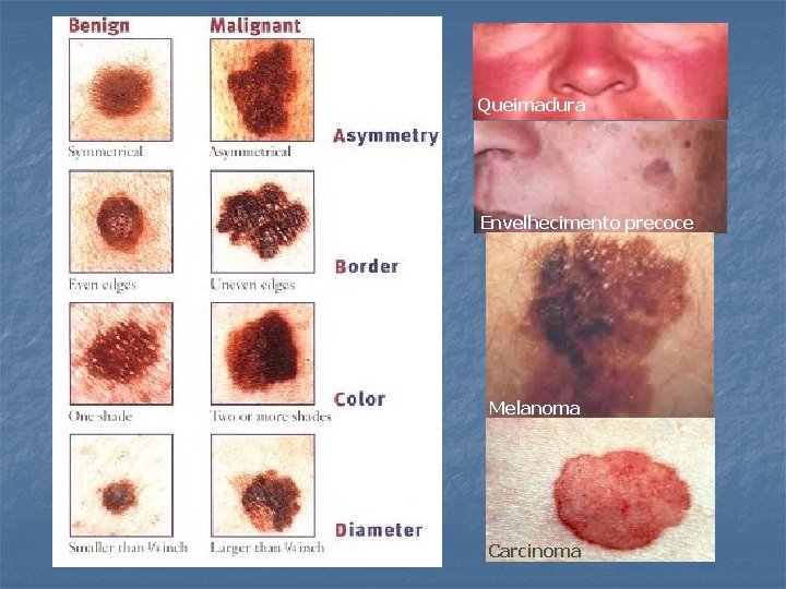 Queimadura Envelhecimento precoce Melanoma Carcinoma 