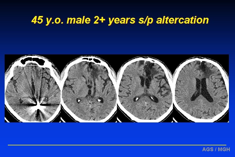 45 y. o. male 2+ years s/p altercation AGS / MGH 