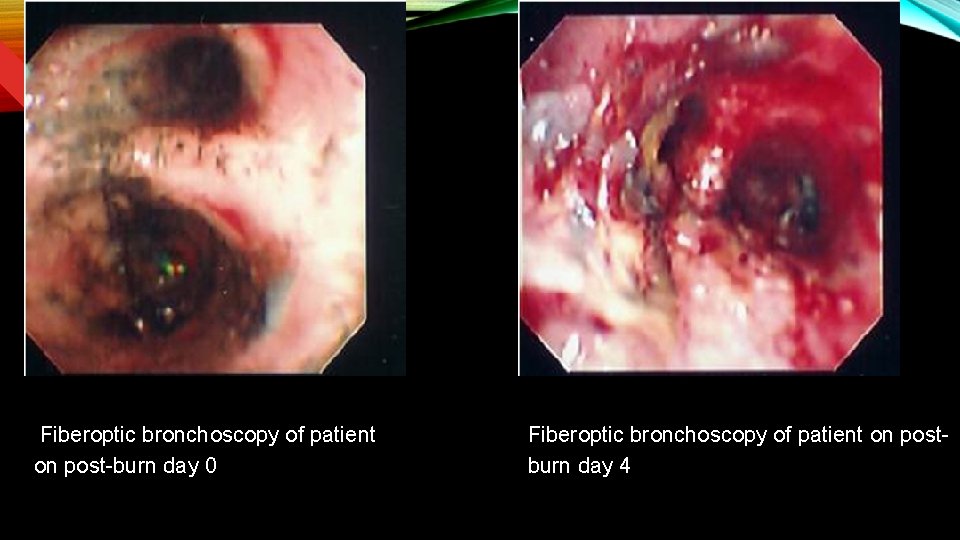 Fiberoptic bronchoscopy of patient on post-burn day 0 Fiberoptic bronchoscopy of patient on postburn