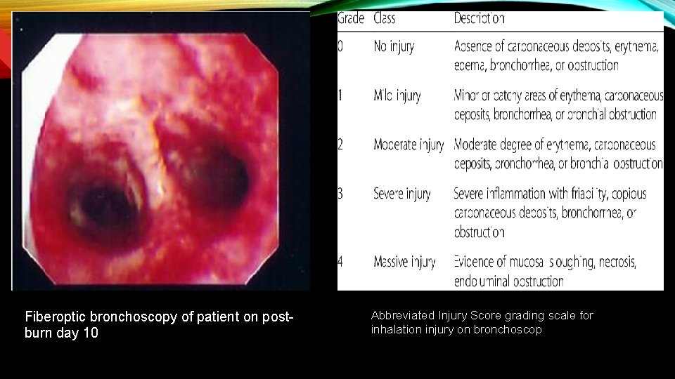 Fiberoptic bronchoscopy of patient on postburn day 10 Abbreviated Injury Score grading scale for