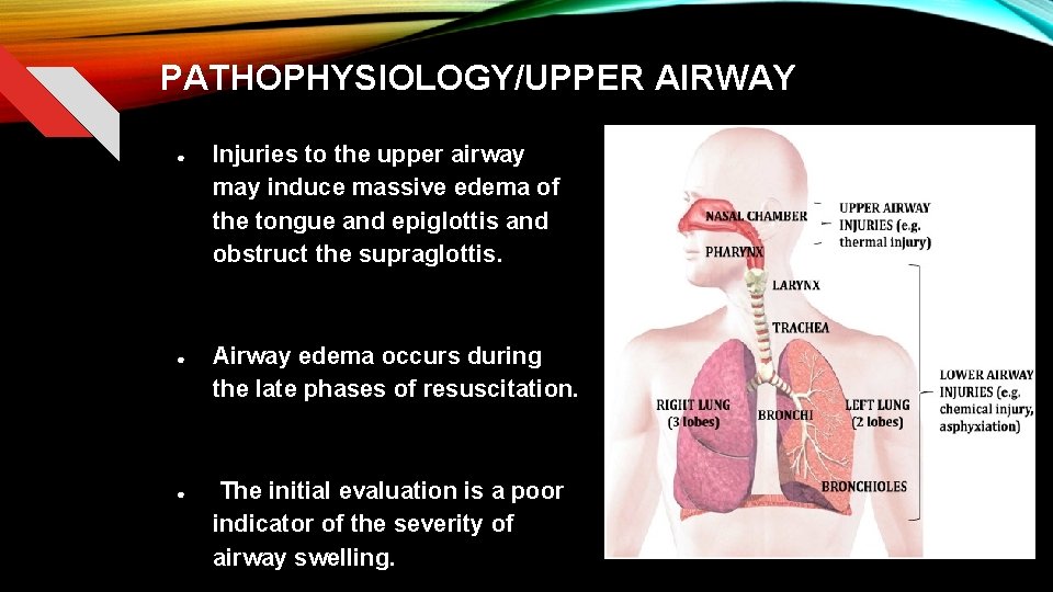 PATHOPHYSIOLOGY/UPPER AIRWAY ● ● ● Injuries to the upper airway may induce massive edema