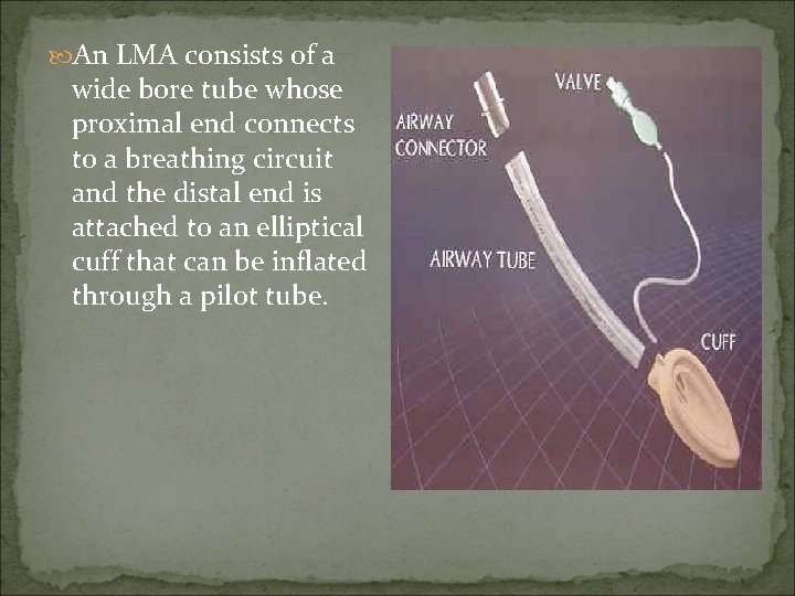  An LMA consists of a wide bore tube whose proximal end connects to