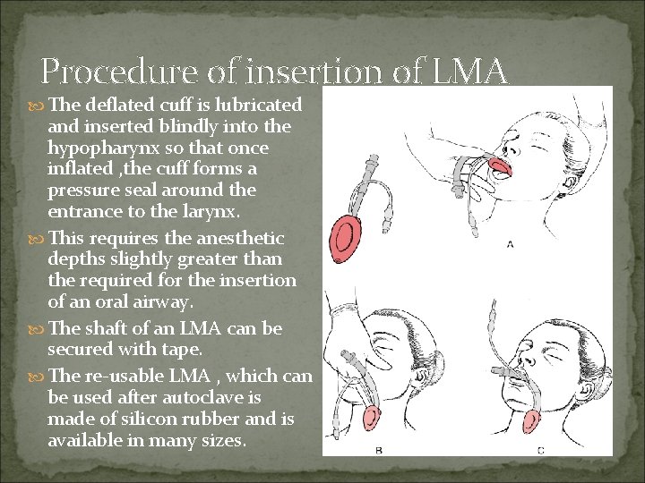 Procedure of insertion of LMA The deflated cuff is lubricated and inserted blindly into