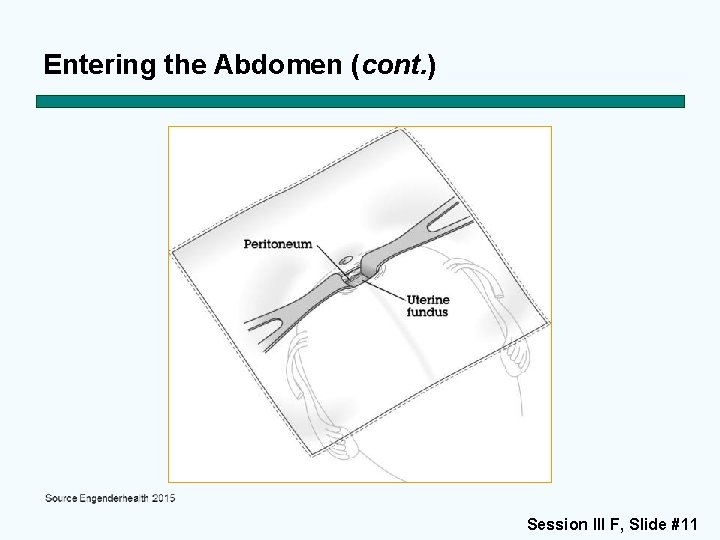 Entering the Abdomen (cont. ) Session III F, Slide #11 
