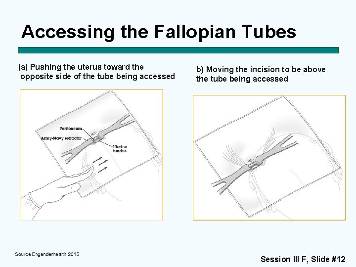 Accessing the Fallopian Tubes (a) Pushing the uterus toward the opposite side of the