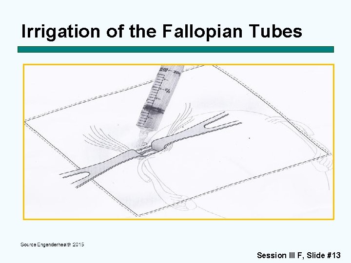 Irrigation of the Fallopian Tubes Session III F, Slide #13 