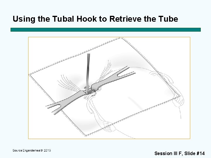 Using the Tubal Hook to Retrieve the Tube Session III F, Slide #14 
