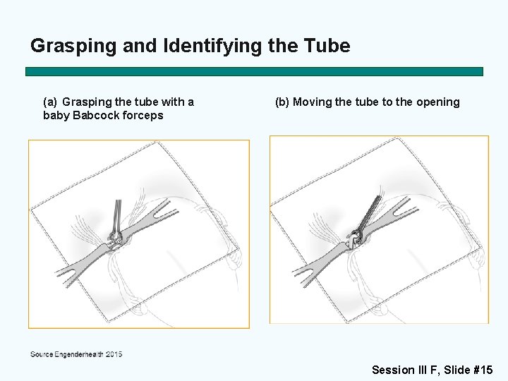 Grasping and Identifying the Tube (a) Grasping the tube with a baby Babcock forceps