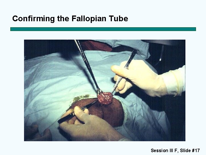 Confirming the Fallopian Tube Session III F, Slide #17 