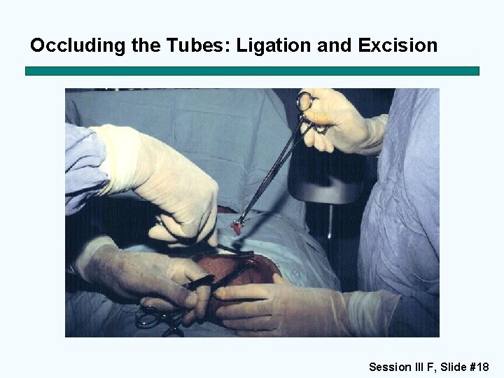 Occluding the Tubes: Ligation and Excision Session III F, Slide #18 