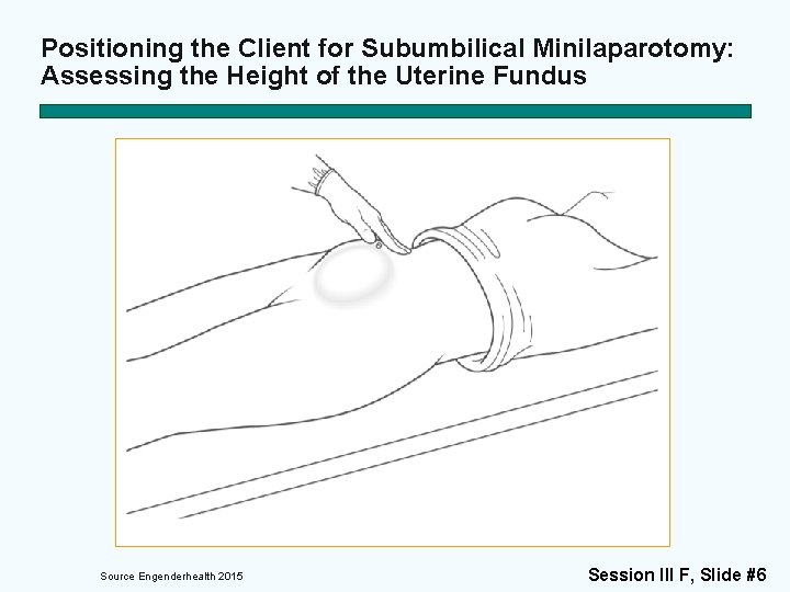 Positioning the Client for Subumbilical Minilaparotomy: Assessing the Height of the Uterine Fundus Source