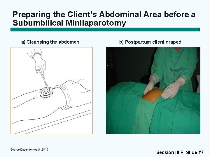 Preparing the Client’s Abdominal Area before a Subumbilical Minilaparotomy a) Cleansing the abdomen b)
